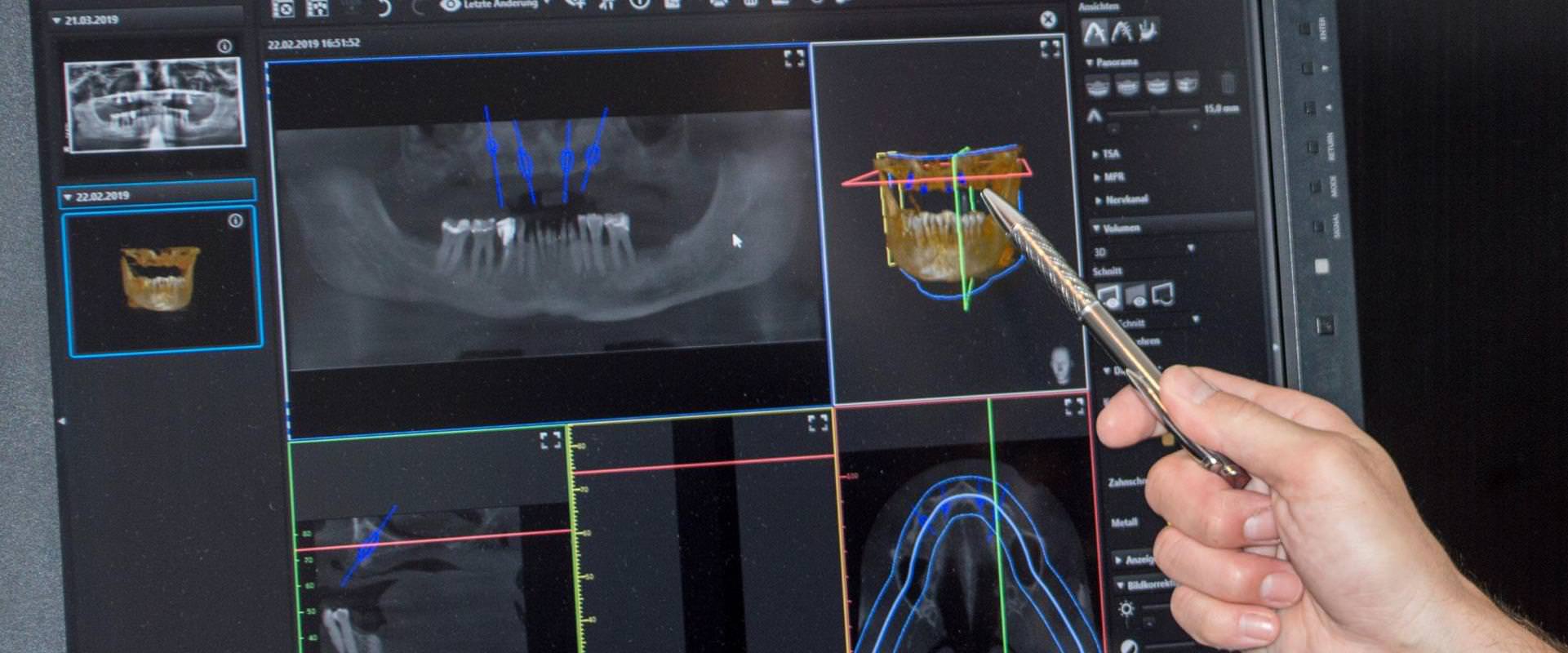 dvt, implantologie, zahnarzt, berchtesgaden, loesch