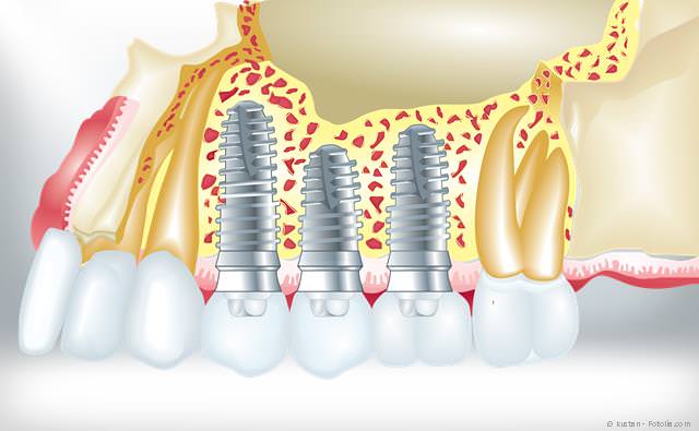 Implantate zum Ersatz fehlender Zähne
