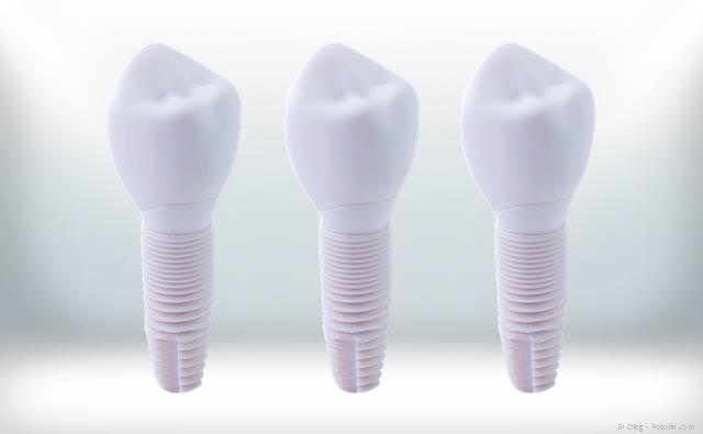 Keramik-Implantate mit Kronen aus Zirkondioxidkeramik: Gut körperverträglich